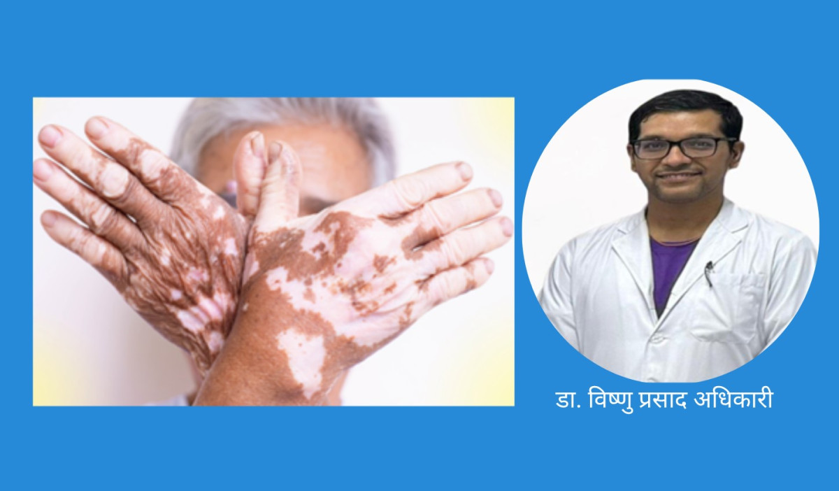 विश्व सेतो दुबी दिवस : रोग छालाको, प्रश्न चेतनाको